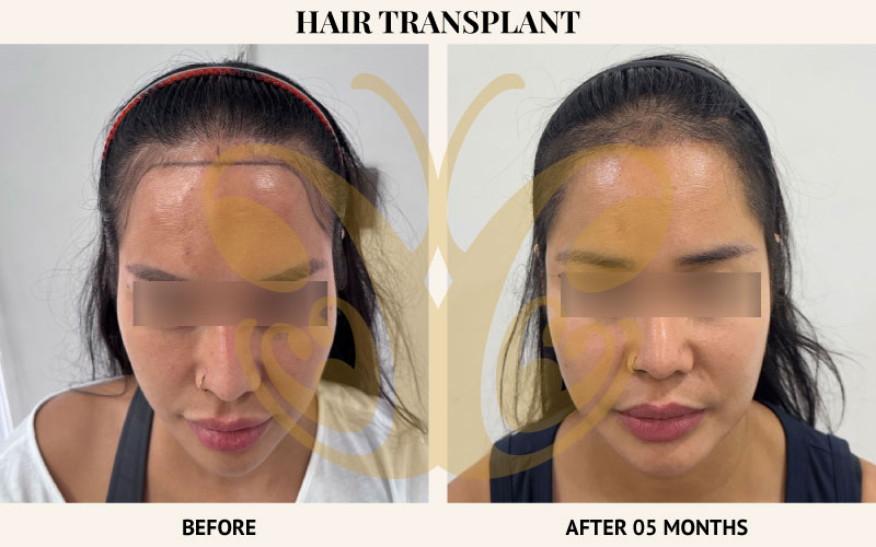 Before and after Hair Transplant at Cocoon Medical Spa Bali