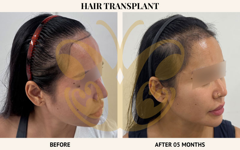 Before and after Hair Transplant results in Legian