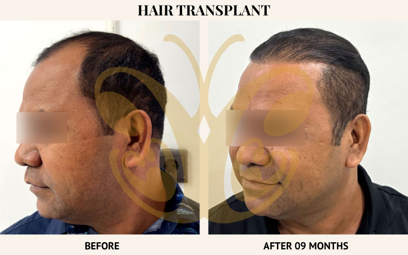 Forehead FUE Hair Transplant in Bali