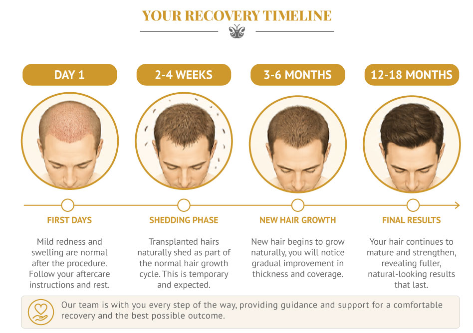 Illustration Fue Hair transplant recovery timeline
