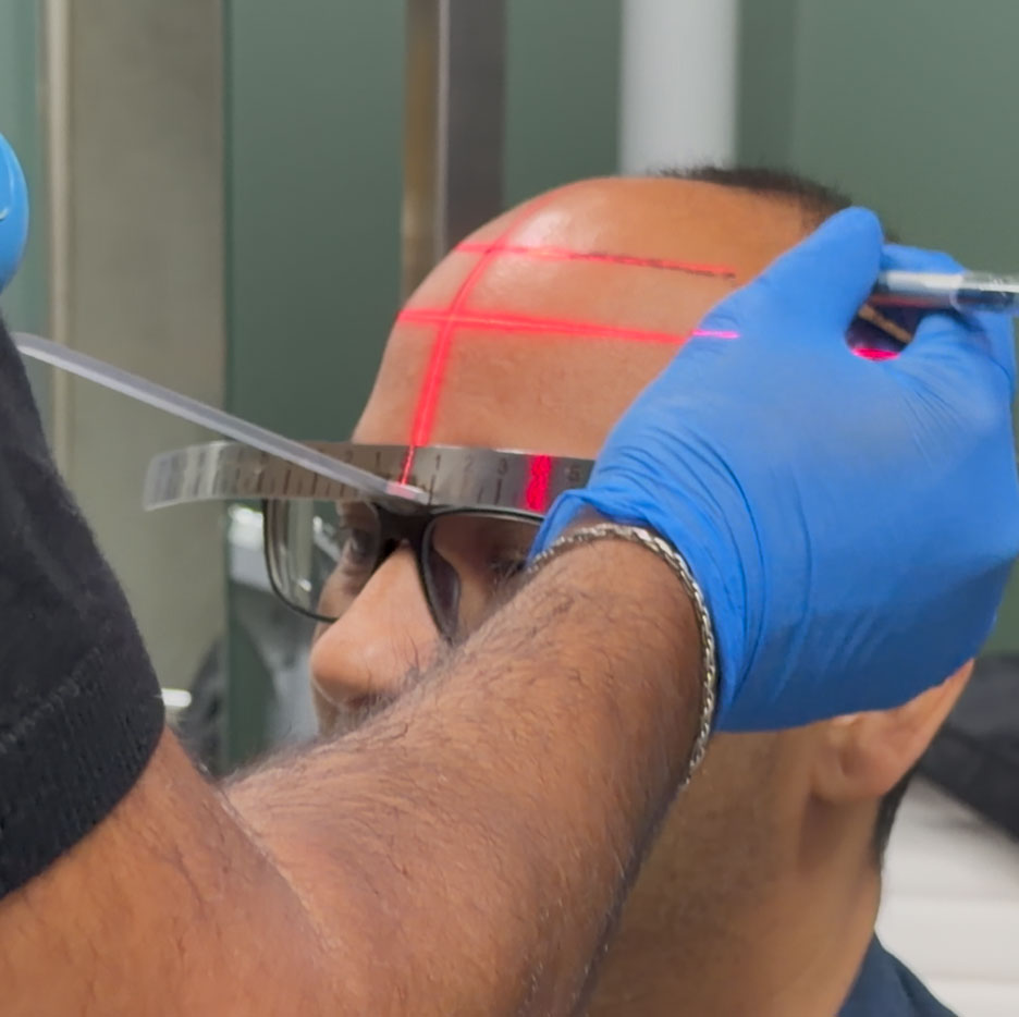 Mapping out for hair transplant in Cocoon Medical Spa
