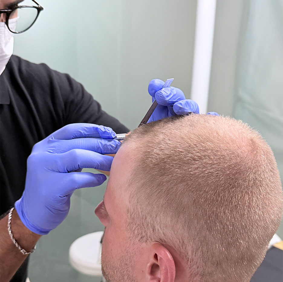 Illustration Hair Transplant The FUE process at Cocoon Medical Spa